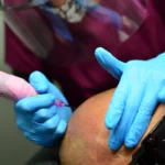 Aftercare in Scalp Micropigmentation